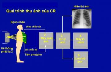 CR là gì ? Cơ bản về hệ thống X quang kỹ thuật số CR