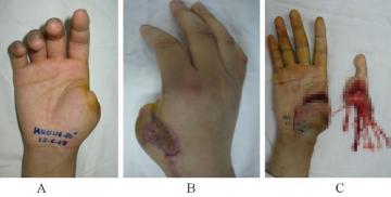 Việt Nam thực hiện thành công phẫu thuật siêu khó tầm cỡ quốc tế: lấy ngón CHÂN cái thay cho ngón TAY cái để phục hồi chức năng bàn tay!